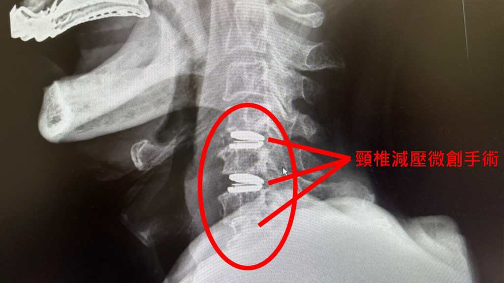 頸椎減壓微創手術。圖／中國醫藥大學新竹附設醫院提供